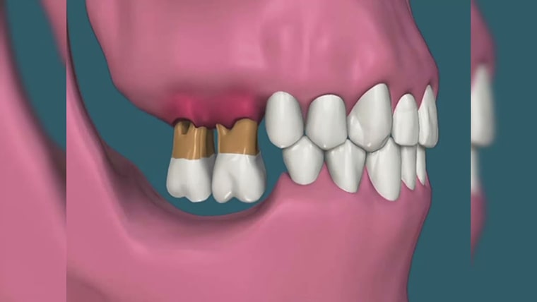 Причины отсутствия нижних зубов