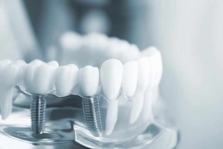 Современное протезирование зубов: методы, процесс, противопоказания