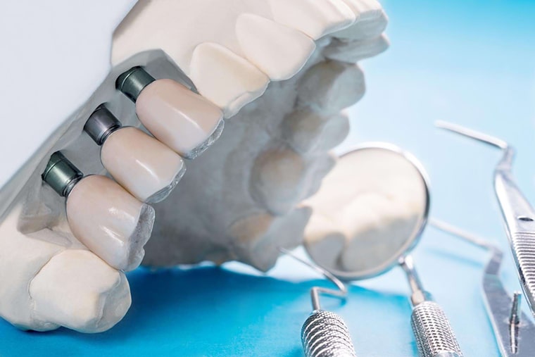 Современное протезирование зубов: методы, процесс, противопоказания