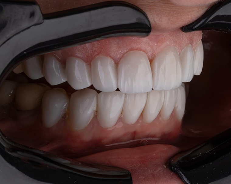 Отсутствие верхних зубов