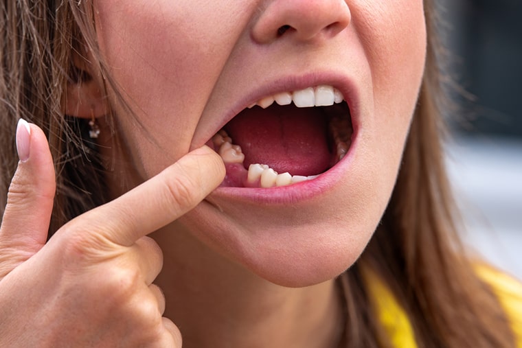 Почему выпадают зубы у взрослого
