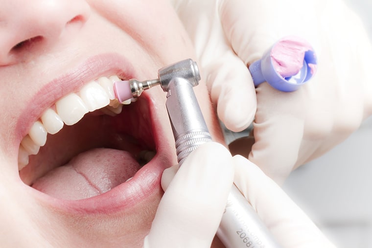 Удаление зубных отложений